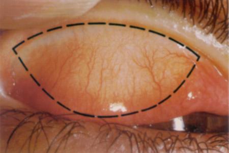 Diagnosing Trachoma 1