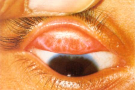 Diagnosing Trachoma 4
