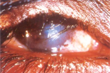 Diagnosing Trachoma 5
