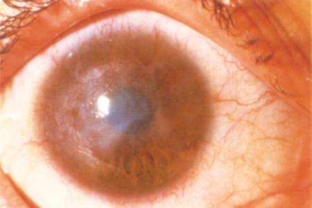 Diagnosing Trachoma 6