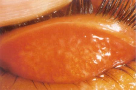 Diagnosing Trachoma 3
